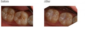 lower sealant on patient's teeth