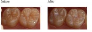 upper sealant on patient's teeth