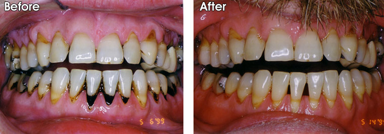 Gum Disease Gallery Dr. Jack M. Hosner, D.D.S.