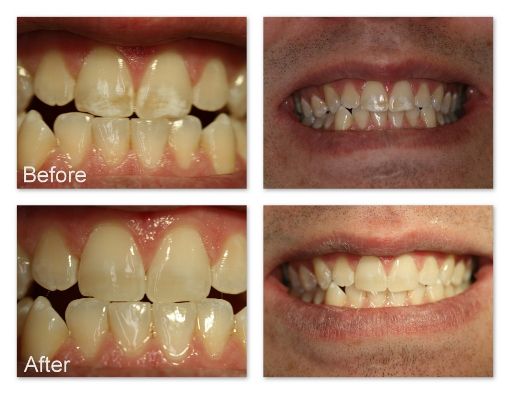 How To Remove Stains From Bonded Teeth At Home at Michael Burton blog