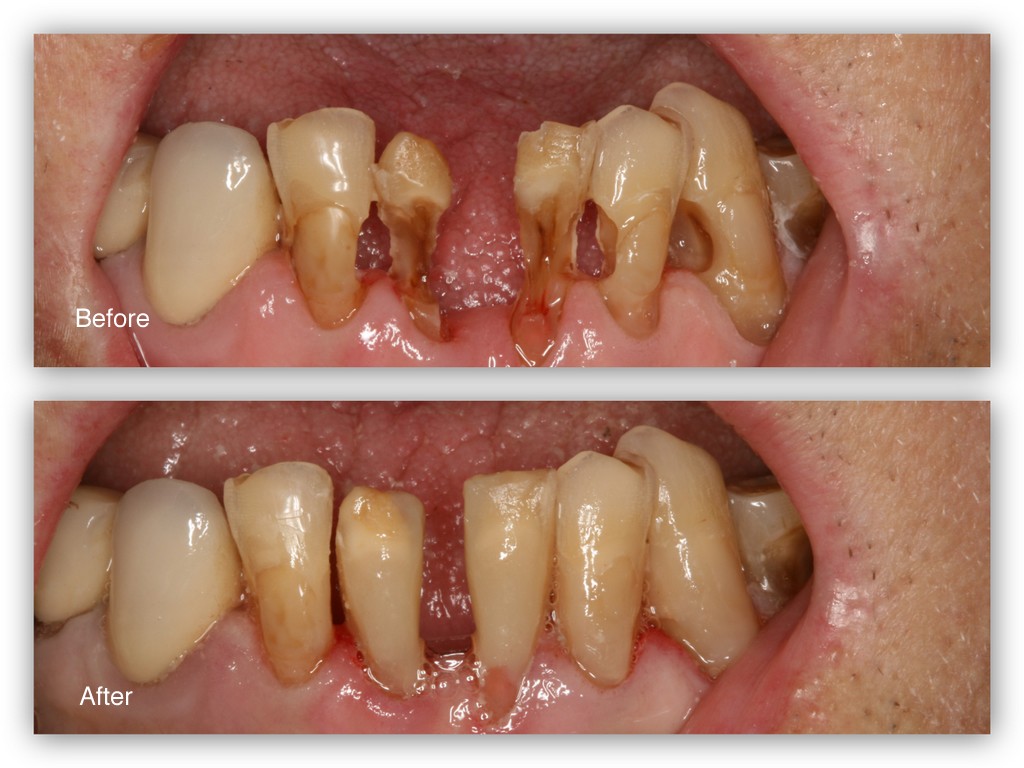 Tooth Colored Fillings Gallery - Hosner Family Dentistry