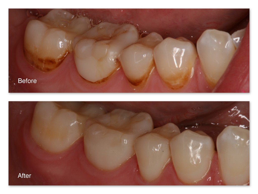 Tooth Stains Gallery Dr. Jack M. Hosner, D.D.S.